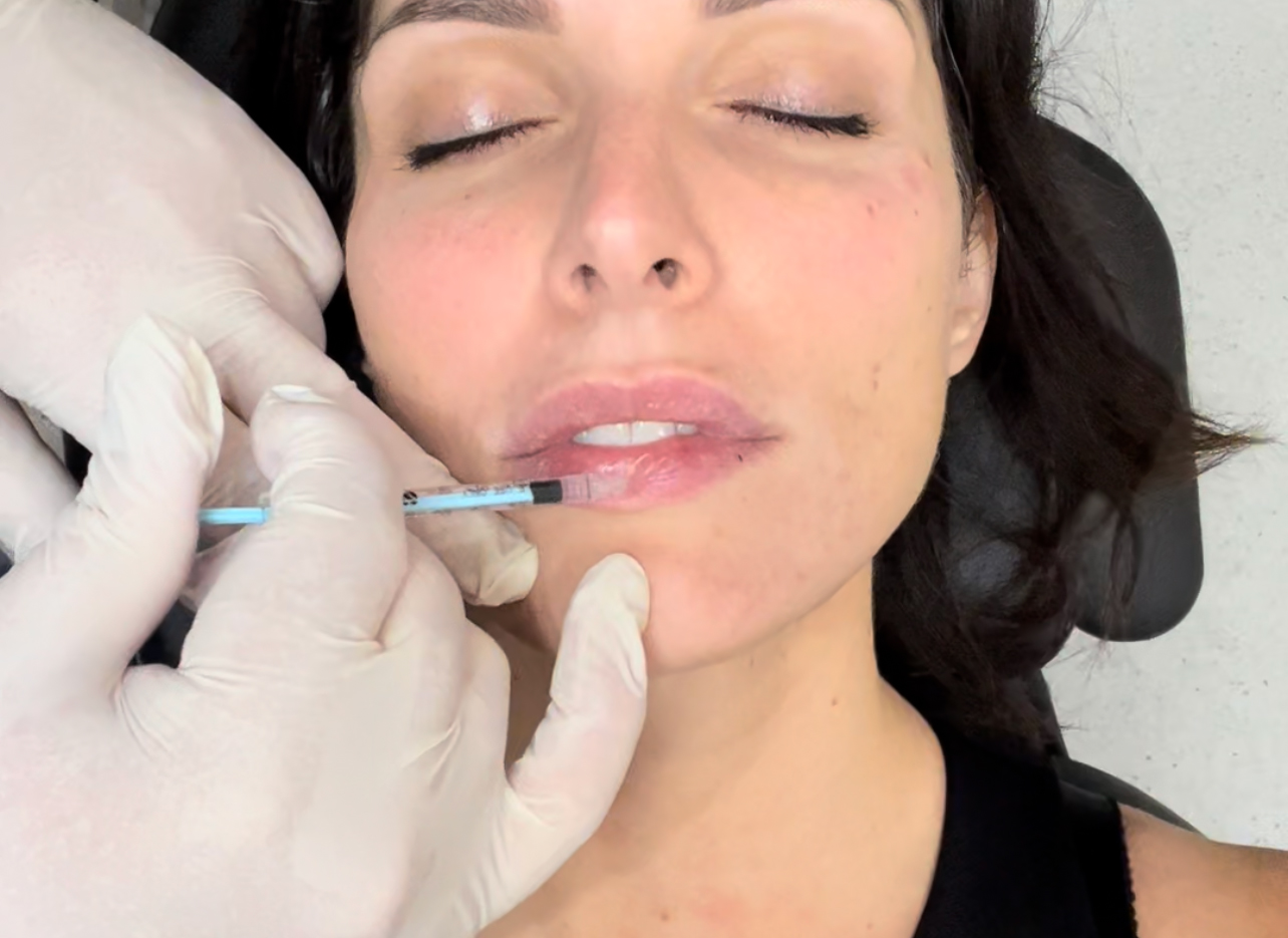 Things to Avoid after Lip Injections – The Dos & Don'ts of Lip Injections -  Dr Hunt - Edgecliff NSW