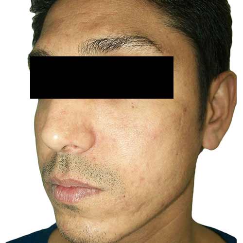 acne scar reduction 3 after