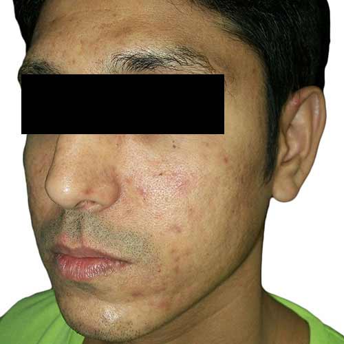 acne scar reduction 3 before