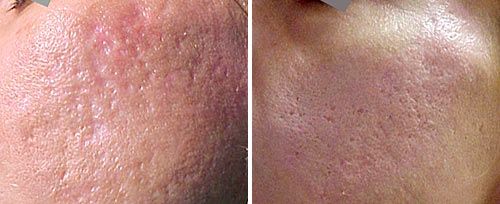 acne scars dr luppino