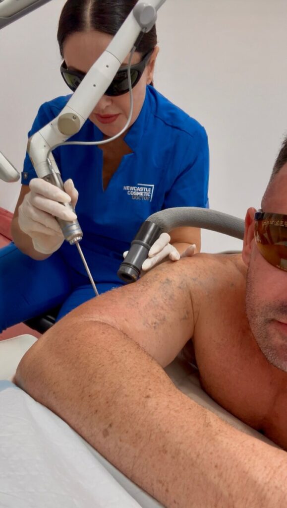 Sharon Leayr performing laser tattoo removal