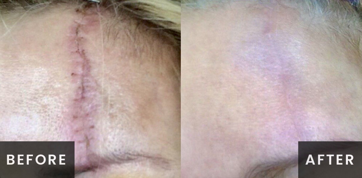 Venus Viva Radiofrequency Before & After Result