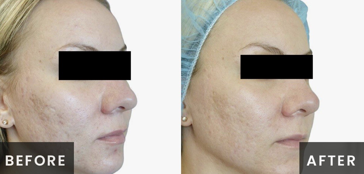Venus Viva Radiofrequency Before & After Result
