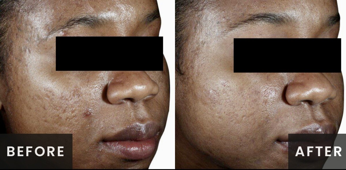 Venus Viva Radiofrequency Before & After Result