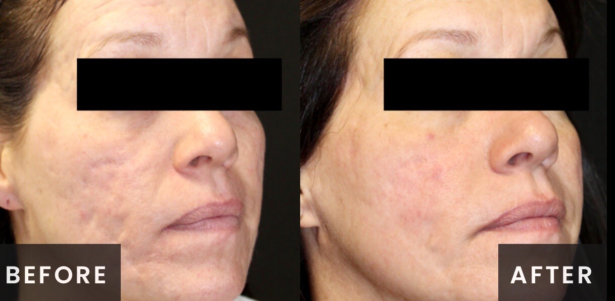Venus Viva Radiofrequency Before & After Result