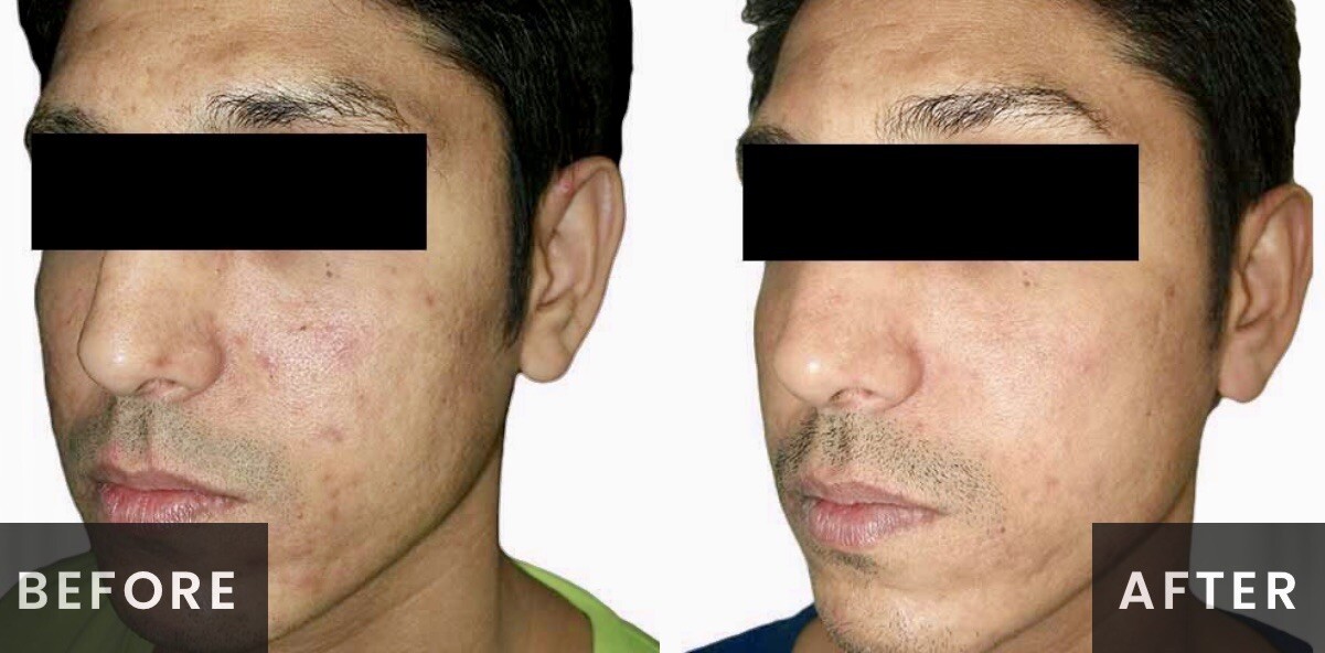 Venus Viva Radiofrequency Before & After Result