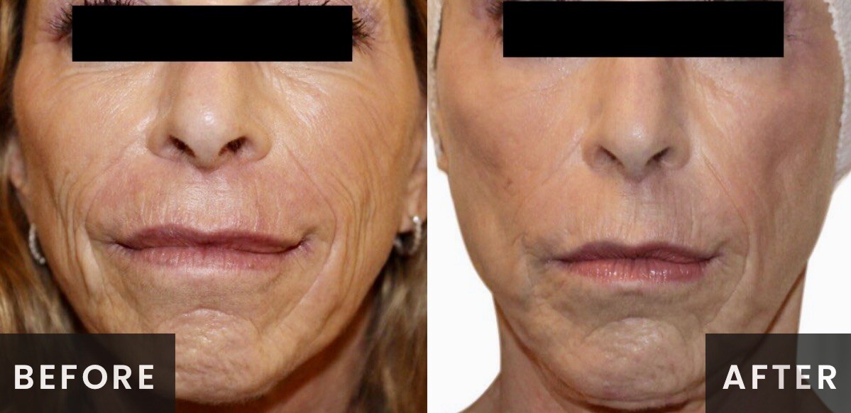 Venus Viva Radiofrequency Before & After Result